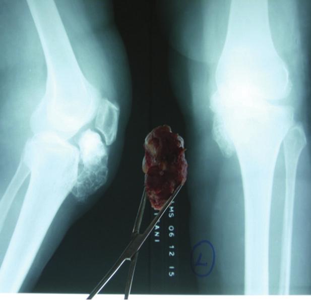osteochondral metaplasia occurring in the fibrous joint capsule or soft tissue adjacent to a joint [6].