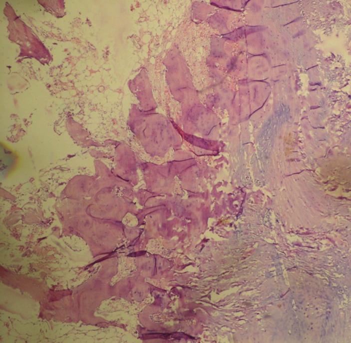 4 Case Reports in Orthopedics Figure 6: Histopathology: This figure shows bone marrow, bone and cartilage with fibrofatty tissue at the periphery.