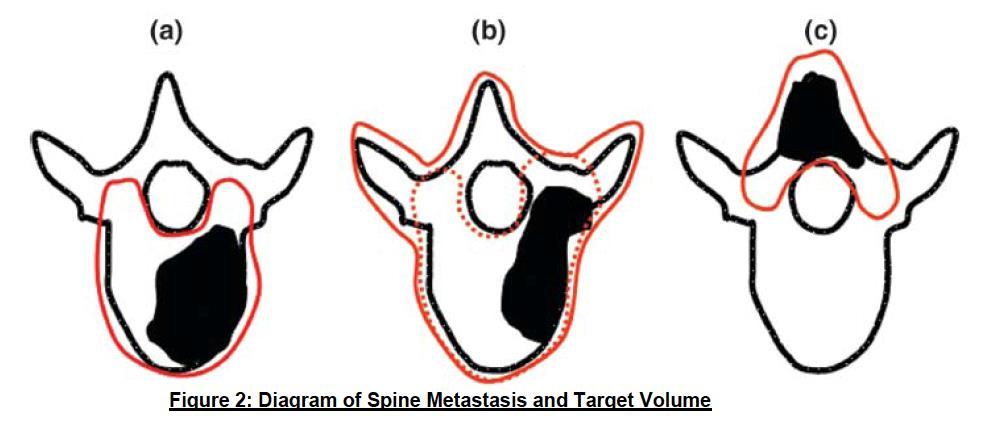 Target volumes Based on MR fused T1 and T2 images Should include the entire vertebral