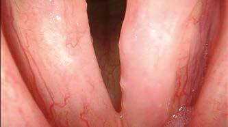 As a result, under narrow-band illumination, capillaries within the mucosal surface are displayed in brown on the
