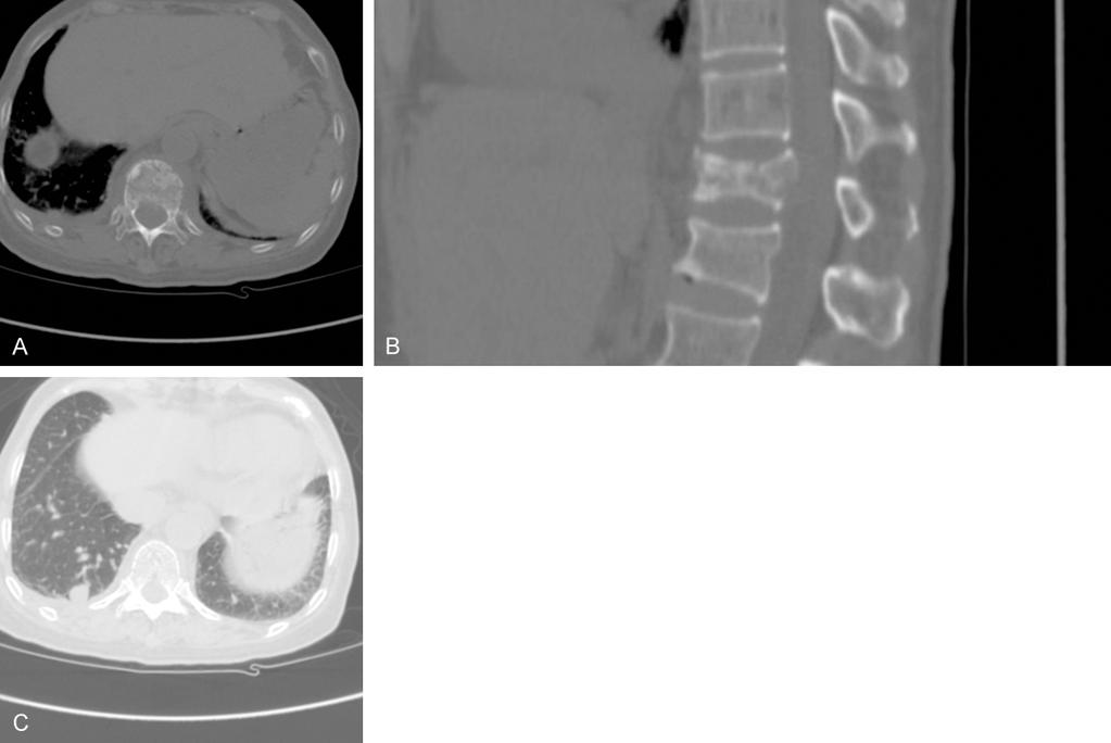 Figure 1. Spinal and chest computed tomography of the twelfth thoracic vertebrae and lung.