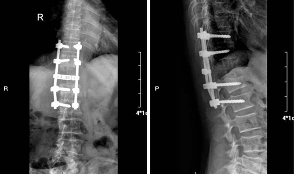Figure 3. Radiographical observations following surgery. The metastatic spine lesion was resected completely and reconstructed using a nanometer bone for tumor prosthesis. Figure 4.