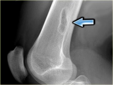 GCT is also included in the differential diagnosis of an ill-defined osteolytic lesion, provided the age and the site of the lesion are compatible.