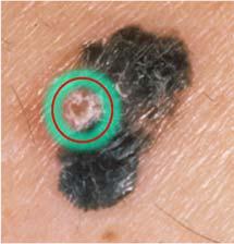 Melanoma Clinical Classification T category By convention, ct is performed after biopsy of the primary melanoma