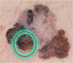 Primary (T) By convention, clinical staging is performed: after biopsy of the primary melanoma (including primary