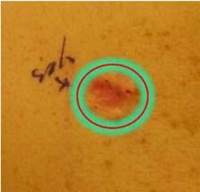gained from both: microstaging of the primary melanoma AND Microstaging of the wide excision AND Pathological