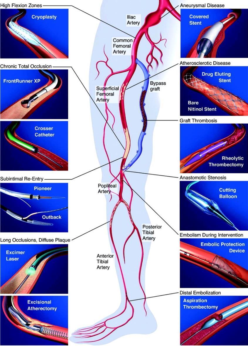 Figure 1. Overview of new technologies for lower extremity revascularization.