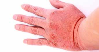 Outcome 2 Explain how to prevent contact dermatitis You can: Portfolio reference / Assessor initials* a. Outline the relevant health and safety legislation b.