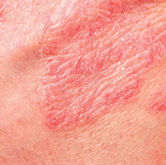 dermatitis Regularly check your
