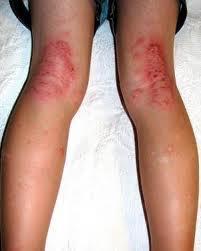 Eczema / dermatitis is an