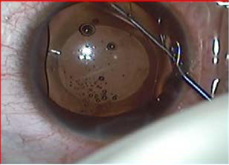 included (21) eyes of (12) patients where the anterior chamber foldable angle fixated IOL (AcrySof Cachet) was implanted.