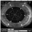 5 Improved Refractive Cataract Surgery IOL Position