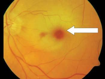 optic nerve central retina (fovea) Fovea-threatening retinal detachment confirm the diagnosis of a retinal tear or detachment by using an indirect ophthalmoscope.