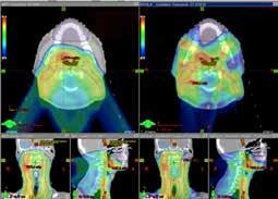 Teaching Material Examples Head and Neck Cancer: Pencil Beam Scanning TREATMENT A. Lin, M.D.