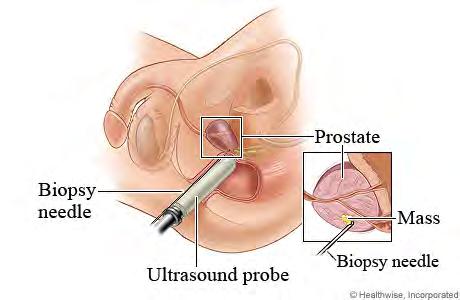 Transurethral Ultrasound Guided