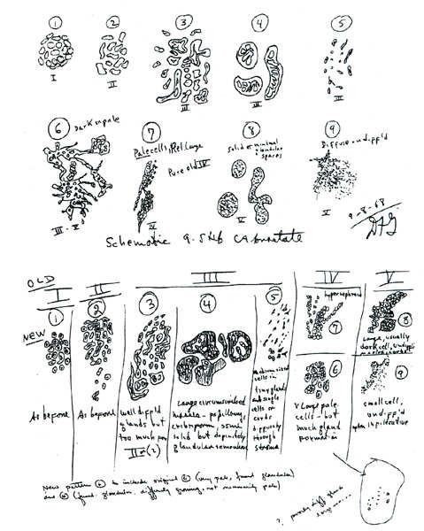 DF Gleason, 1966 Gleason pattern 1: Circumscribed nodule