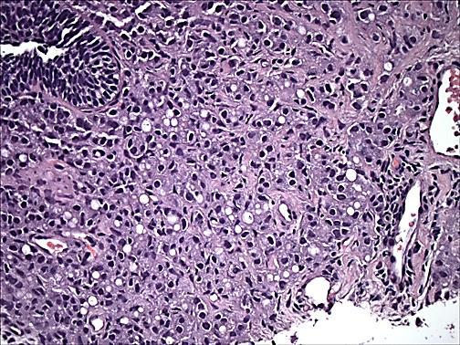 Tumor glands floating in mucin (mucinous carcinoma not all 4) Tumor with columnar cells (Ductal Ca) not always 4 Tumor cells with vacuoles seen in Gleason patterns 3, 4 or 5.