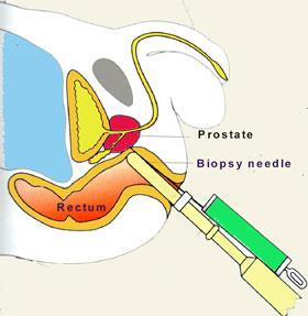 Needle biopsy Standard approach - image guidance using transrectal ultrasound usual for 1 st attempt at
