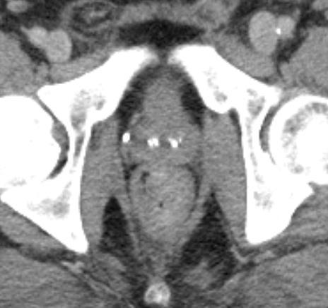 Prostate Cancer: Computed Tomography Not effective local staging Routine screening for comorbid disease not cost effective* Nodes: routine imaging not justified** Selected