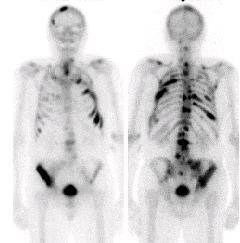 PROSTATE CANCER Radionuclide Bone Scan Pre-Treatment Evaluation: Staging Radionuclide bone