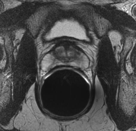 MRI Prostate T2-weighted Images Prostate zonal anatomy displayed