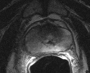 Prostate - MRI Benign Prostatic Hyperplasia (BPH) Small vol.