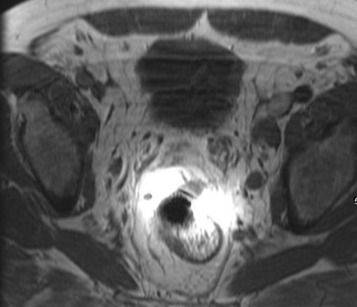 MRI Prostate T1-weighted Pelvis Prostate homogeneous low intensity