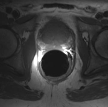 MRI Prostate T1-weighted Pelvis Prostate homogeneous low intensity like CT Bone