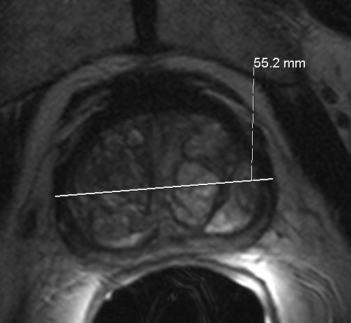 to anterior rectal margin Calculate ellipsoid volume (4/3 PI * width axis