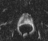 MRI: Diffusion weighted imaging = DWI A method of prostate cancer detection in the peripheral