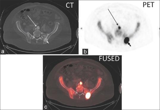 18 F Sodium Fluoride PET/CT More sensitive than traditional bone scan Risk of false positive sites detected Example: 2 hot spots the larger one is a metastasis, the smaller one is degenerative bone