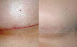 Benefits of Intralesional 5-Fluorouracil for Hypertrophic Scars 595-nm LPDL Improve scar softness and pliability Reduce scar height Improve scar color Enhanced efficacy without side-effects