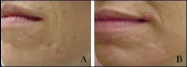 Ablative fractional resurfacing (AFR) ~50-75% improvement after 2-3 treatment sessions.
