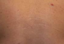 NAFR Ablative Fractional Resurfacing Acne Scars 1 Month after 4 treatments 40 mj,