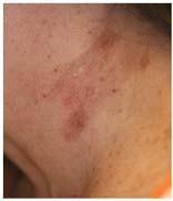 Hypertrophic / Erythematous Atrophic Hyperpigmented Hypopigmented Surgical Burn or Traumatic Hyperpigmented and
