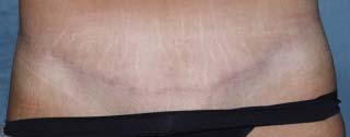 Fractional photothermolysis for the Treatment of surgical scars: A case report. J Cosmetic Laser Ther, 2006; 8:35-38. Capon A, Iarmarcovai G, Mordon S.