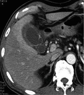 Severity assessment criteria for acute cholecystitis; TG13 Background Patients with acute cholecystitis may present a spectrum of disease stages ranging from a mild, self-limited