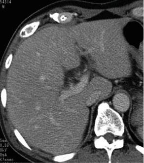 cholecystitis was classified into the following 3 categories: mild (Grade I), moderate (Grade II) and severe (Grade III).