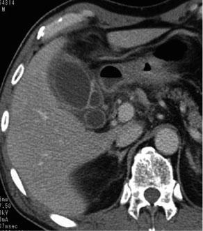 Moderate (Grade II) acute cholecystitis was defined as acute cholecystitis in which the degree of acute inflammation is likely to be associated with increased operative difficulty in