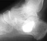 replacement by native cancellous bone. Ossilix is radiopaque and visible under fluoroscopy to allow proper placement of hardware and to ensure the cancellous defect has been completely filled.