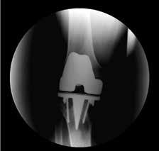 Fracture X-ray showing on