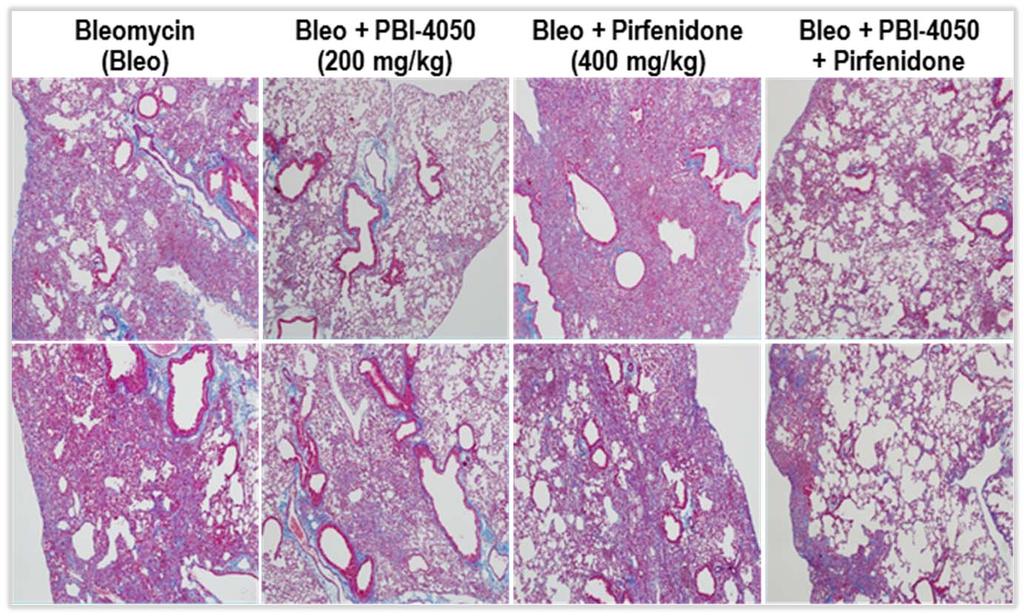 Histological lesions in bleomycin (bleo)-induced lung fibrosis reduced by PBI-4050 alone and by PBI-4050 + pirfenidone combination Photomicrographs of lung tissue from mice treated with PBI-4050
