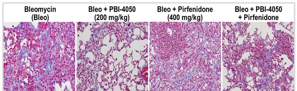 Histological lesions in bleomycin (bleo)-induced lung fibrosis reduced by PBI-4050 alone and by PBI-4050 +