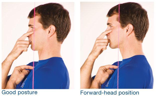 A forward-head position represents tightness in the cervical extensors and lengthening of