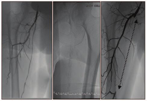 The Role of Atherectomy in the Femoropopliteal Artery With the growing number of tools for femoropopliteal artery intervention, what is the role of atherectomy in the endovascular treatment of