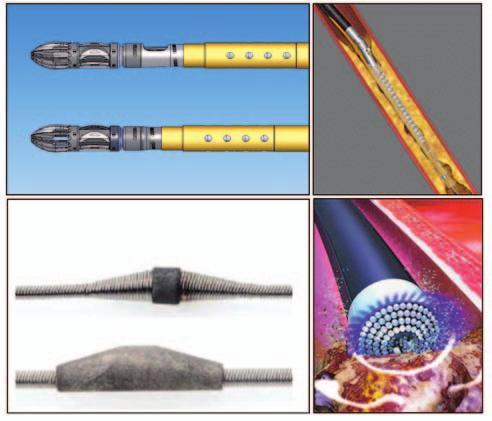 Before the availability of atherectomy technologies, the unpredictability of a balloonangioplasty-alone outcome resulted in some reluctance to approach such disease using endovascular techniques.