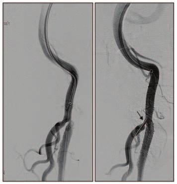 Balloon angioplasty of such plaque was often ineffective due to failure to achieve adequate balloon expansion.