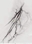 In addition, a recent study by Nikanorov et al that subjected a variety of stents in a cadaver model to what were believed to be clinically relevant axial compression and bending forces showed high