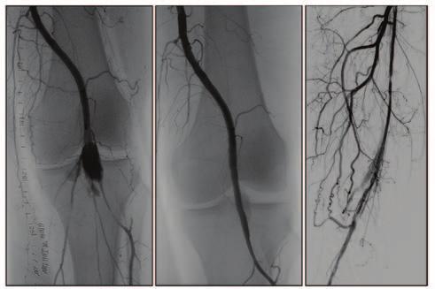 Figure 8. Potential complications of atherectomy in the FP artery.
