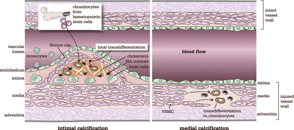 Neven and D Haese Uremic Animal Models for Vascular Calcification 259 Figure 2. Current hypothesis of the origin of chondrocyte-like cells involved in arterial intimal versus medial calcification.
